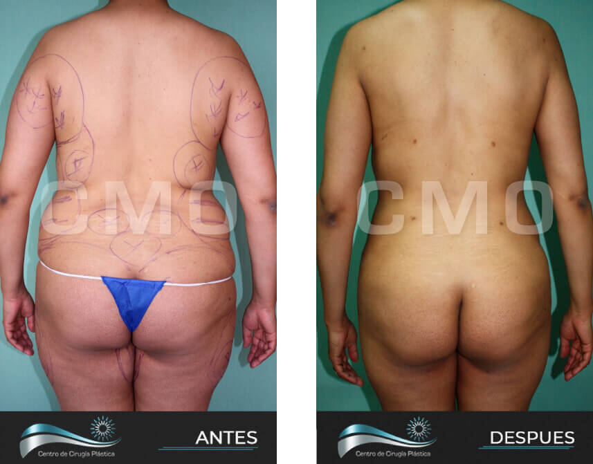 Mini-Abdominoplastia – Cirujano Plástico Quito – Dr. Marco Vinicio