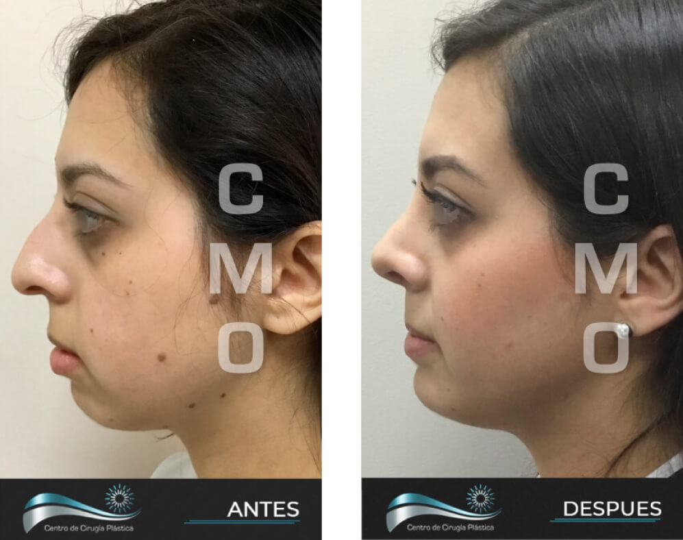 Dr-Marco-Vinicio-Ochoa-Cirugia-Plastica-Estetica-y-Reconstructiva-Quito-CASOS-RINOPLAstia-a1