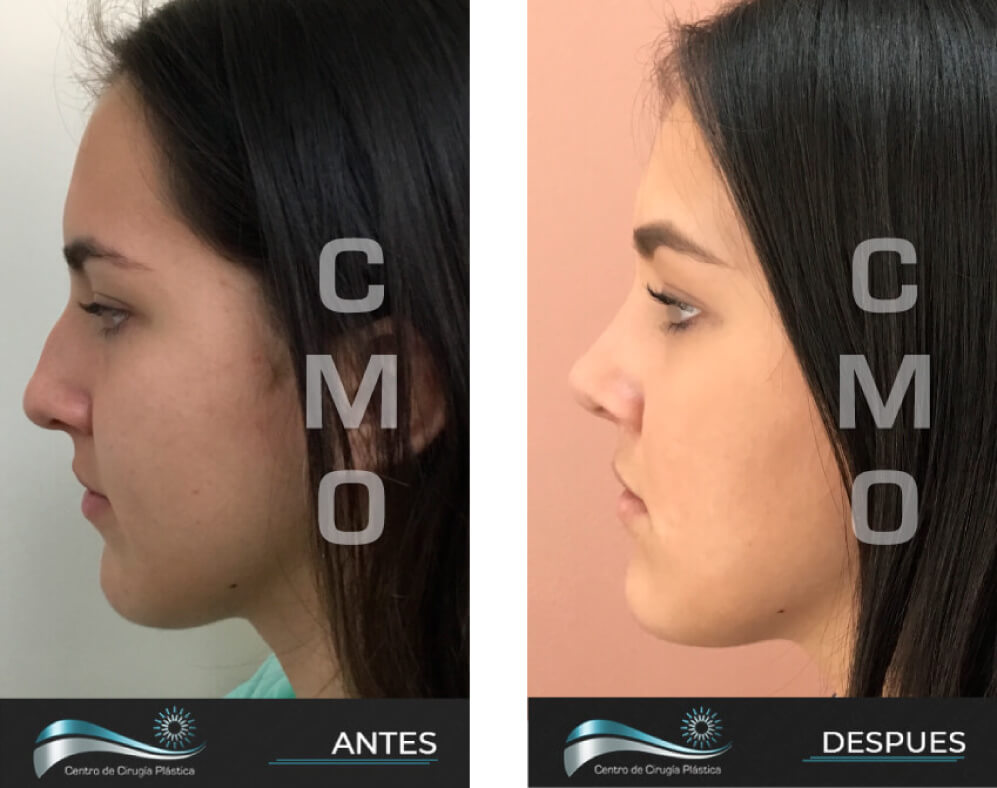 Dr-Marco-Vinicio-Ochoa-Cirugia-Plastica-Estetica-y-Reconstructiva-Quito-CASOS-RINOPLAstia-b1