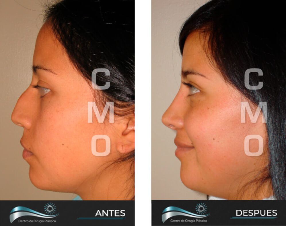 Dr-Marco-Vinicio-Ochoa-Cirugia-Plastica-Estetica-y-Reconstructiva-Quito-CASOS-RINOPLAstia-e1