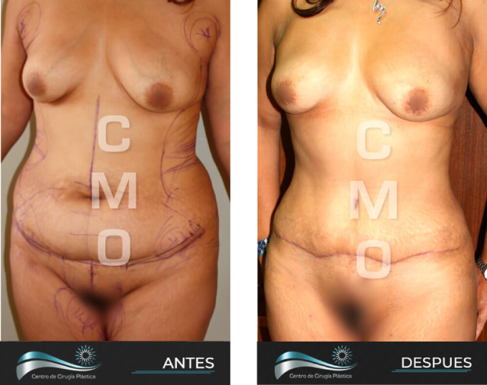 Dr-Marco-Vinicio-Ochoa-Cirugia-Plastica-Estetica-y-Reconstructiva-Quito-CASOS-abdominoplastia-a2