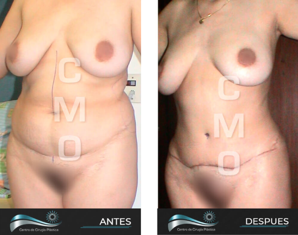 Dr-Marco-Vinicio-Ochoa-Cirugia-Plastica-Estetica-y-Reconstructiva-Quito-CASOS-abdominoplastia-b1