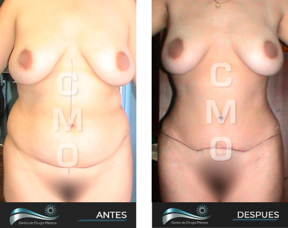 Dr-Marco-Vinicio-Ochoa-Cirugia-Plastica-Estetica-y-Reconstructiva-Quito-CASOS-abdominoplastia-b2