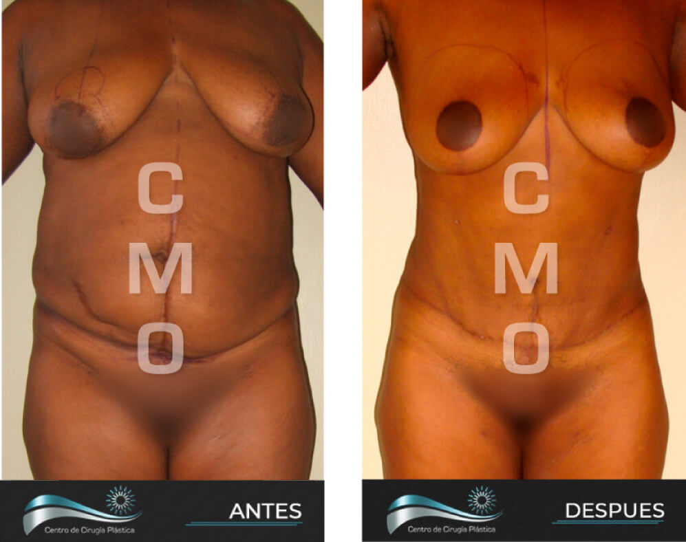 Dr-Marco-Vinicio-Ochoa-Cirugia-Plastica-Estetica-y-Reconstructiva-Quito-CASOS-abdominoplastia-c1-