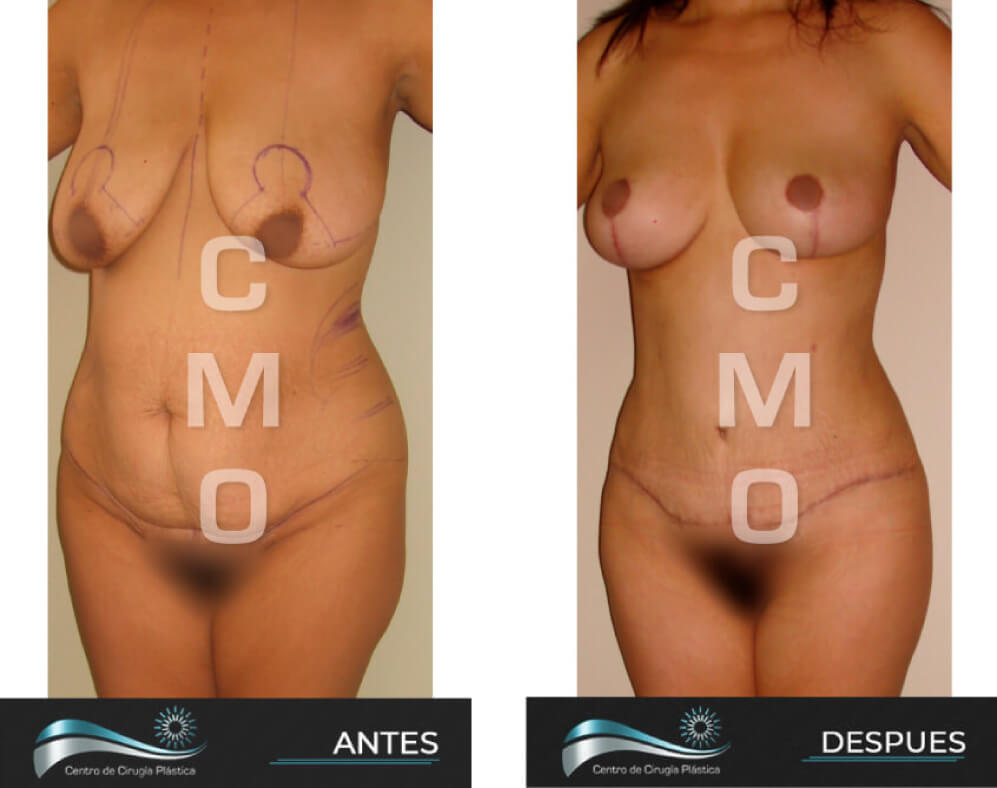 Dr-Marco-Vinicio-Ochoa-Cirugia-Plastica-Estetica-y-Reconstructiva-Quito-CASOS-abdominoplastia-c1