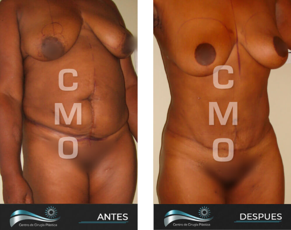 Dr-Marco-Vinicio-Ochoa-Cirugia-Plastica-Estetica-y-Reconstructiva-Quito-CASOS-abdominoplastia-c2-