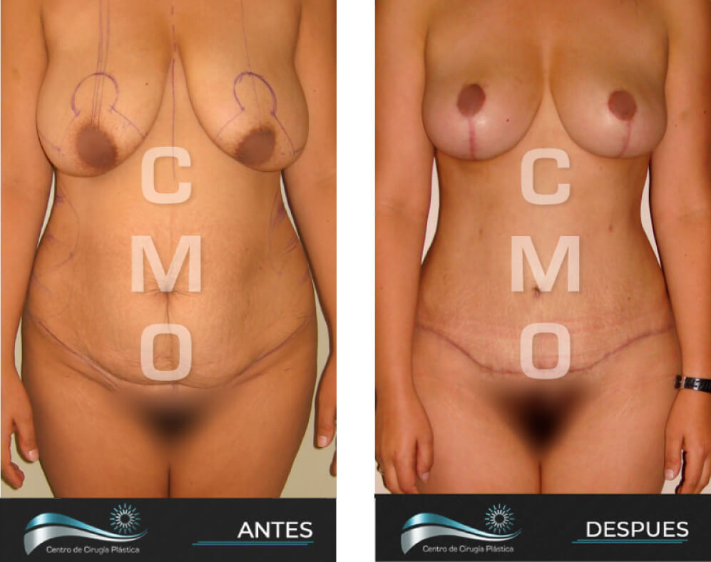 Dr-Marco-Vinicio-Ochoa-Cirugia-Plastica-Estetica-y-Reconstructiva-Quito-CASOS-abdominoplastia-c2