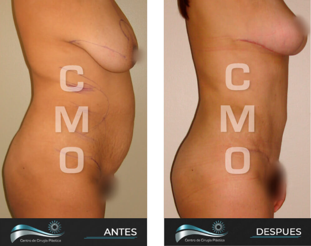 Dr-Marco-Vinicio-Ochoa-Cirugia-Plastica-Estetica-y-Reconstructiva-Quito-CASOS-abdominoplastia-c3