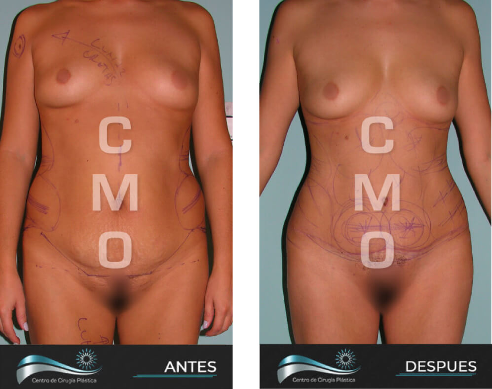 Dr-Marco-Vinicio-Ochoa-Cirugia-Plastica-Estetica-y-Reconstructiva-Quito-CASOS-abdominoplastia-e1