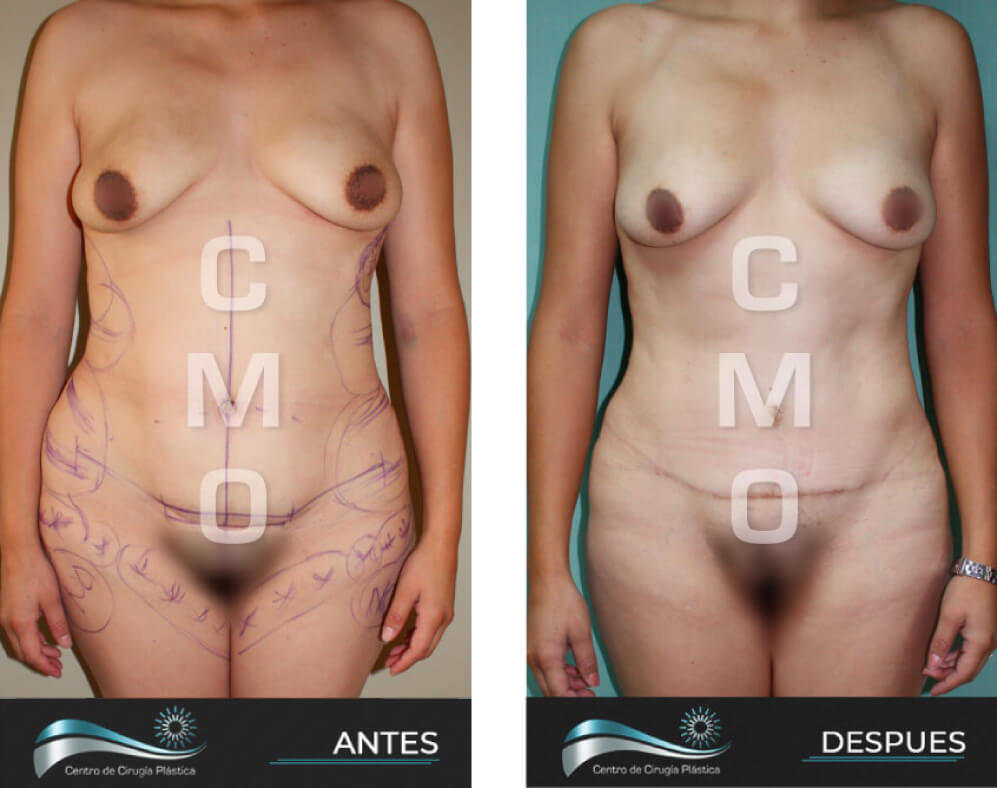 Dr-Marco-Vinicio-Ochoa-Cirugia-Plastica-Estetica-y-Reconstructiva-Quito-CASOS-abdominoplastia-f1