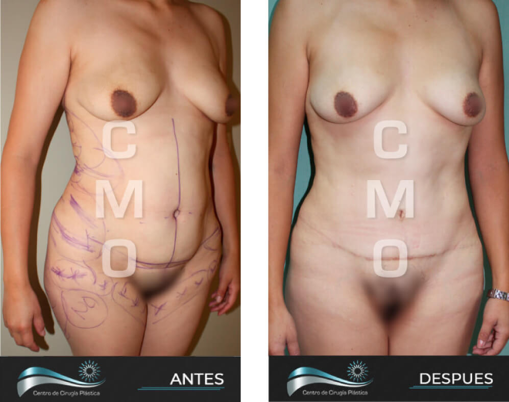 Dr-Marco-Vinicio-Ochoa-Cirugia-Plastica-Estetica-y-Reconstructiva-Quito-CASOS-abdominoplastia-f2