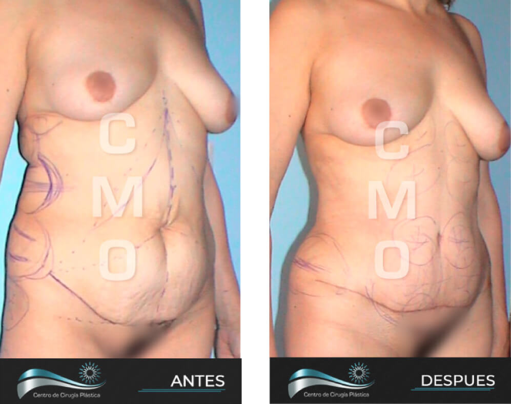 Dr-Marco-Vinicio-Ochoa-Cirugia-Plastica-Estetica-y-Reconstructiva-Quito-CASOS-abdominoplastia-g1