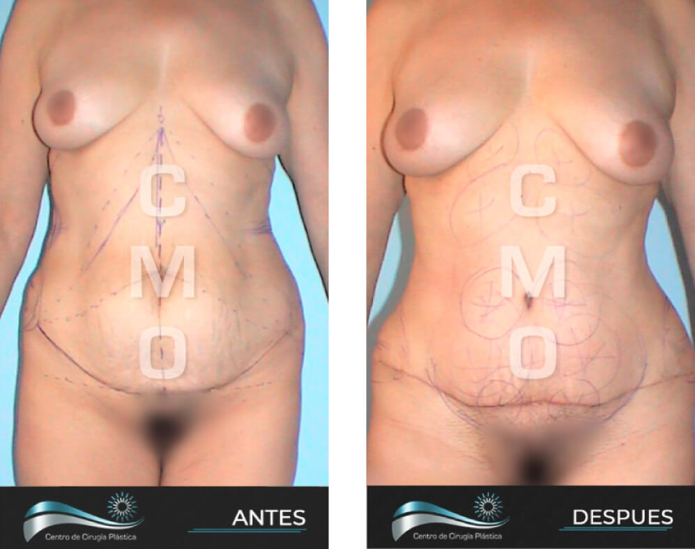 Dr-Marco-Vinicio-Ochoa-Cirugia-Plastica-Estetica-y-Reconstructiva-Quito-CASOS-abdominoplastia-g2