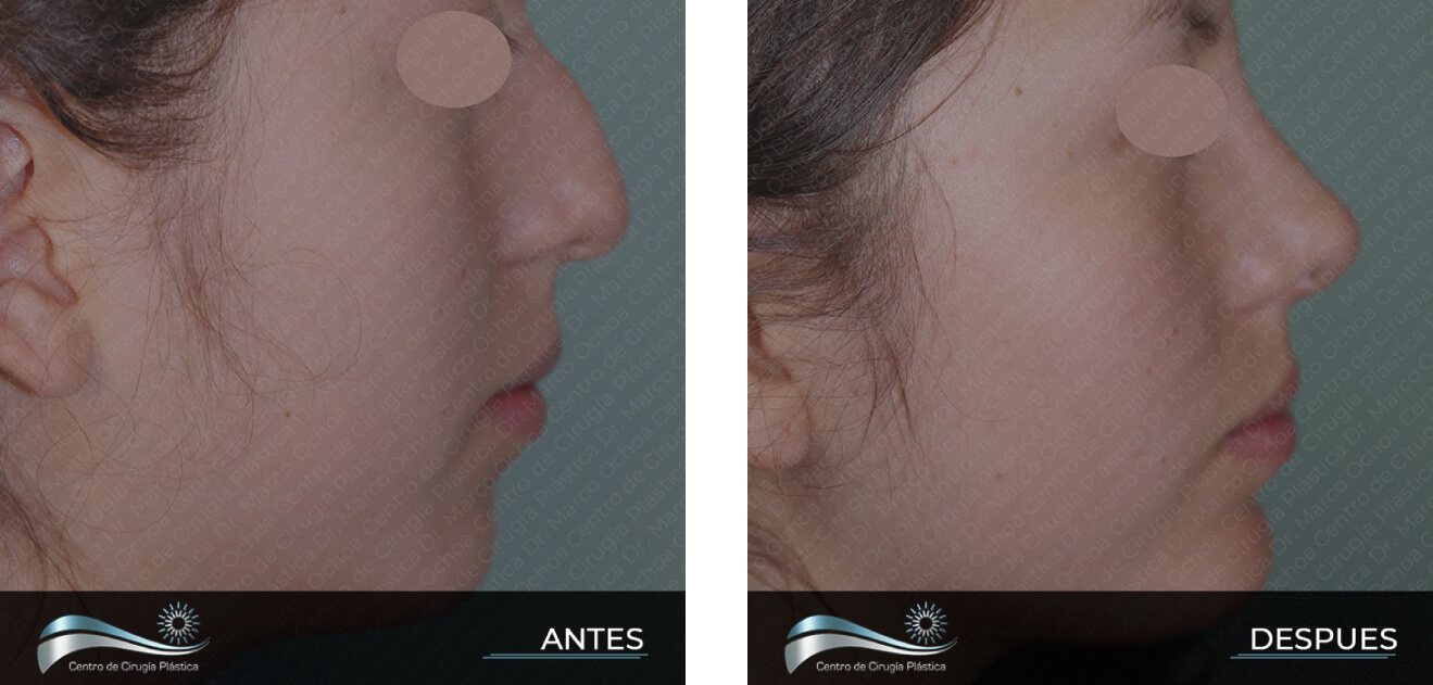 Dr-Marco-Vinicio-Ochoa-Cirugia-Plastica-Estetica-y-Reconstructiva-Quito-CASOS-genioplastia-menton-b1