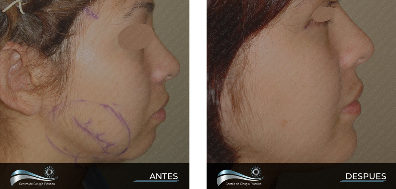 Dr-Marco-Vinicio-Ochoa-Cirugia-Plastica-Estetica-y-Reconstructiva-Quito-CASOS-genioplastia-menton-c1