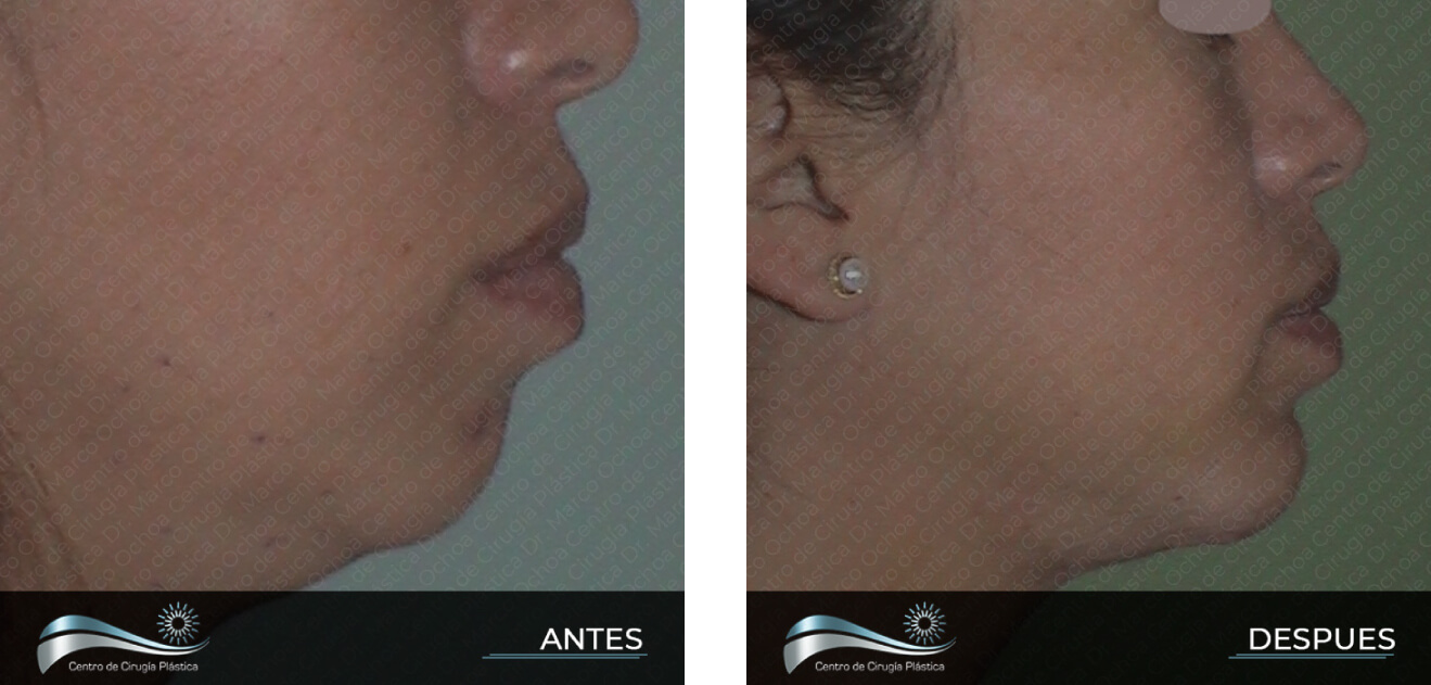 Dr-Marco-Vinicio-Ochoa-Cirugia-Plastica-Estetica-y-Reconstructiva-Quito-CASOS-genioplastia-menton-d1