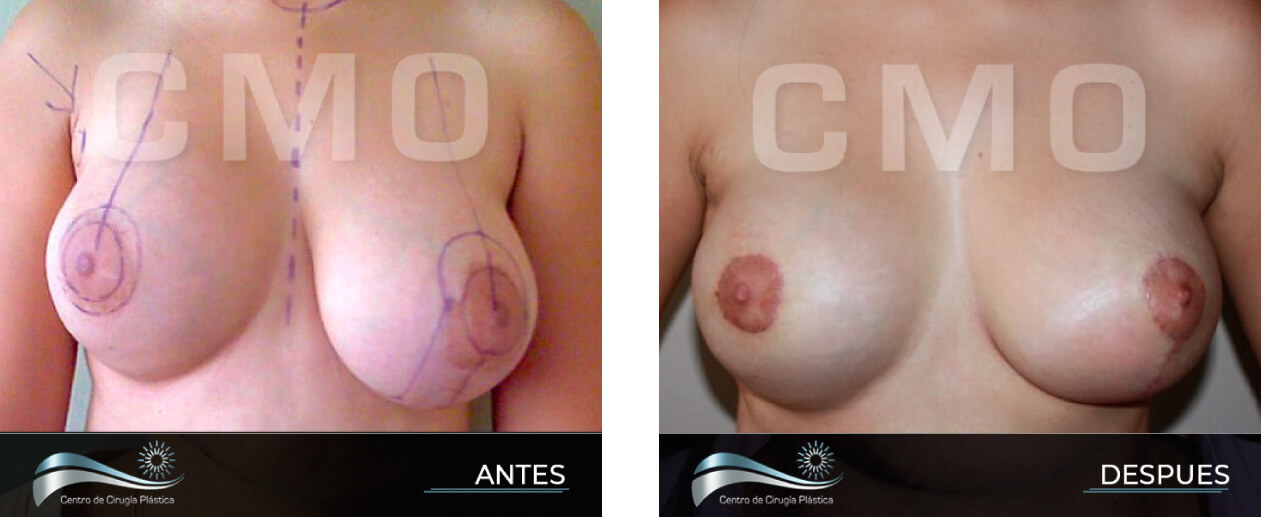 Dr-Marco-Vinicio-Ochoa-Cirugia-Plastica-Estetica-y-Reconstructiva-Quito-CASOS-levantamiento-de-senos-A1