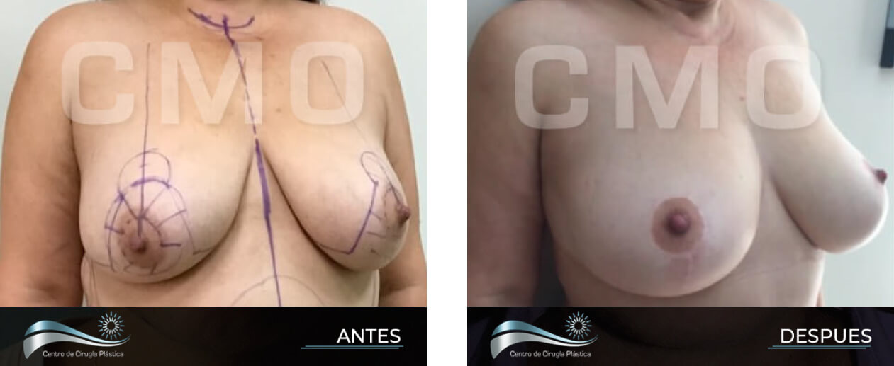 Dr-Marco-Vinicio-Ochoa-Cirugia-Plastica-Estetica-y-Reconstructiva-Quito-CASOS-levantamiento-de-senos-D2