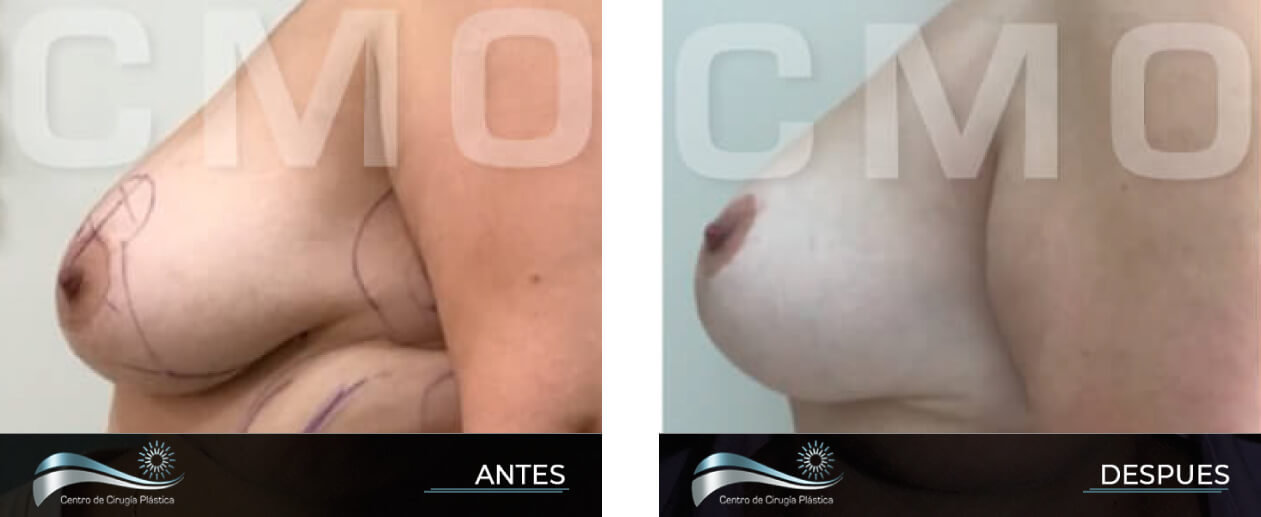 Dr-Marco-Vinicio-Ochoa-Cirugia-Plastica-Estetica-y-Reconstructiva-Quito-CASOS-levantamiento-de-senos-d1