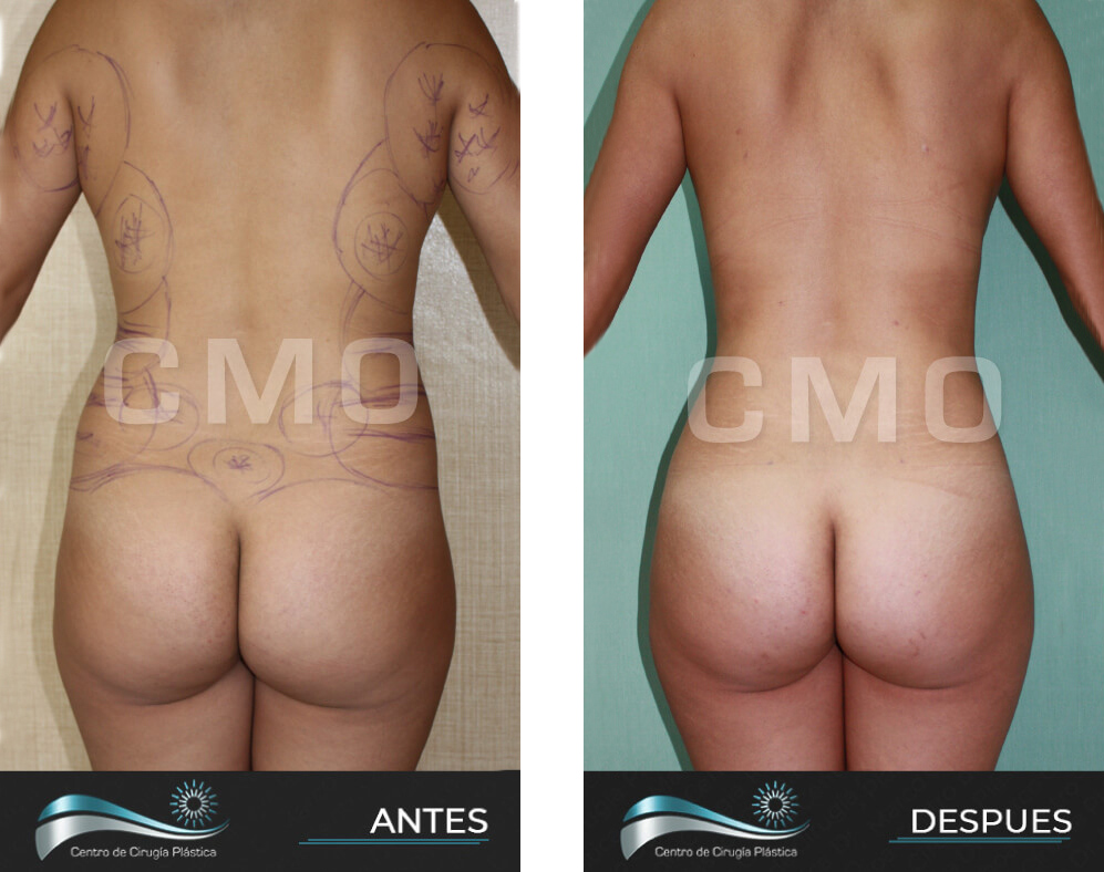 Dr-Marco-Vinicio-Ochoa-Cirugia-Plastica-Estetica-y-Reconstructiva-Quito-CASOS-lipoescultura-2b