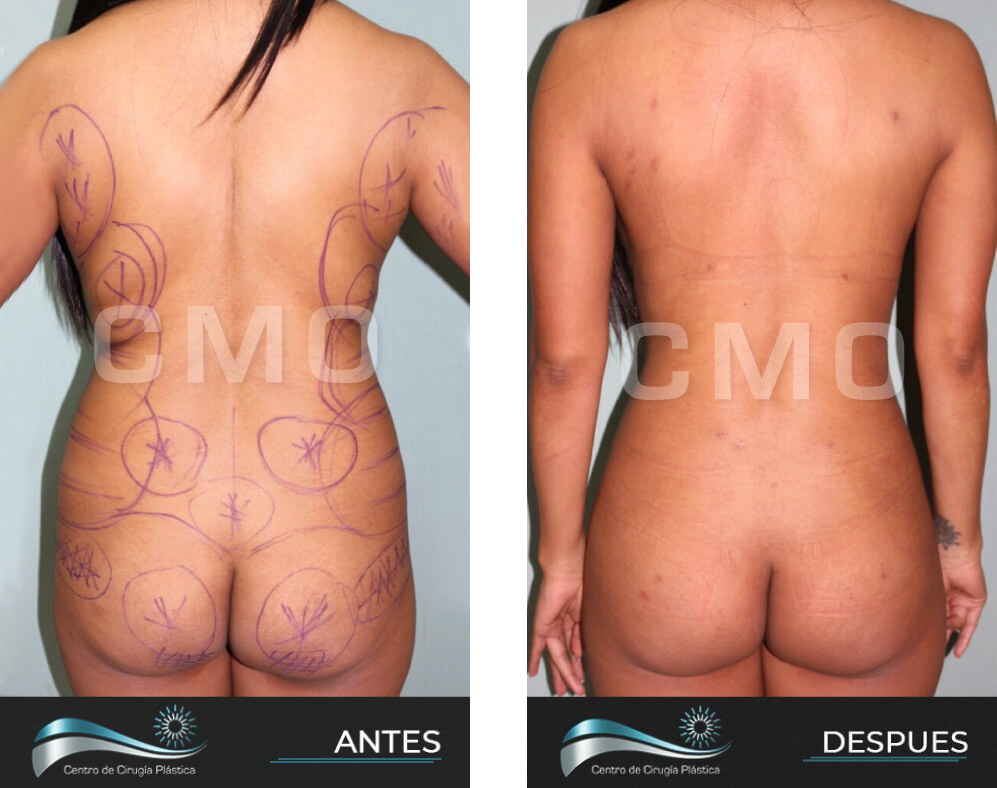 Dr-Marco-Vinicio-Ochoa-Cirugia-Plastica-Estetica-y-Reconstructiva-Quito-CASOS-lipoescultura-3a