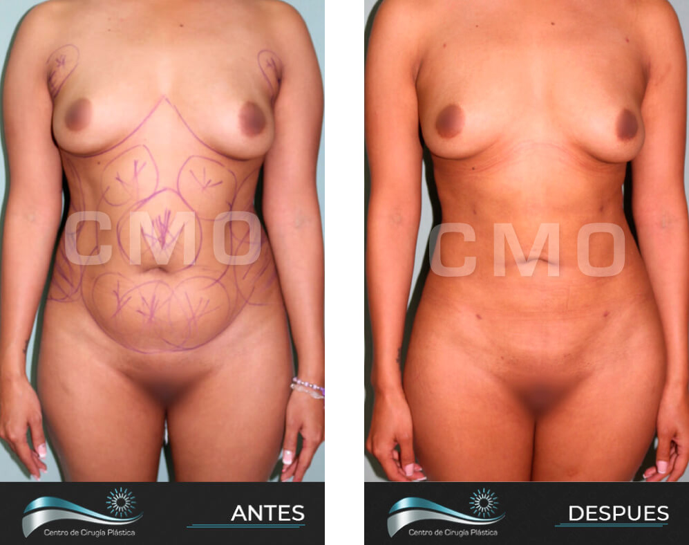 Dr-Marco-Vinicio-Ochoa-Cirugia-Plastica-Estetica-y-Reconstructiva-Quito-CASOS-lipoescultura-3b