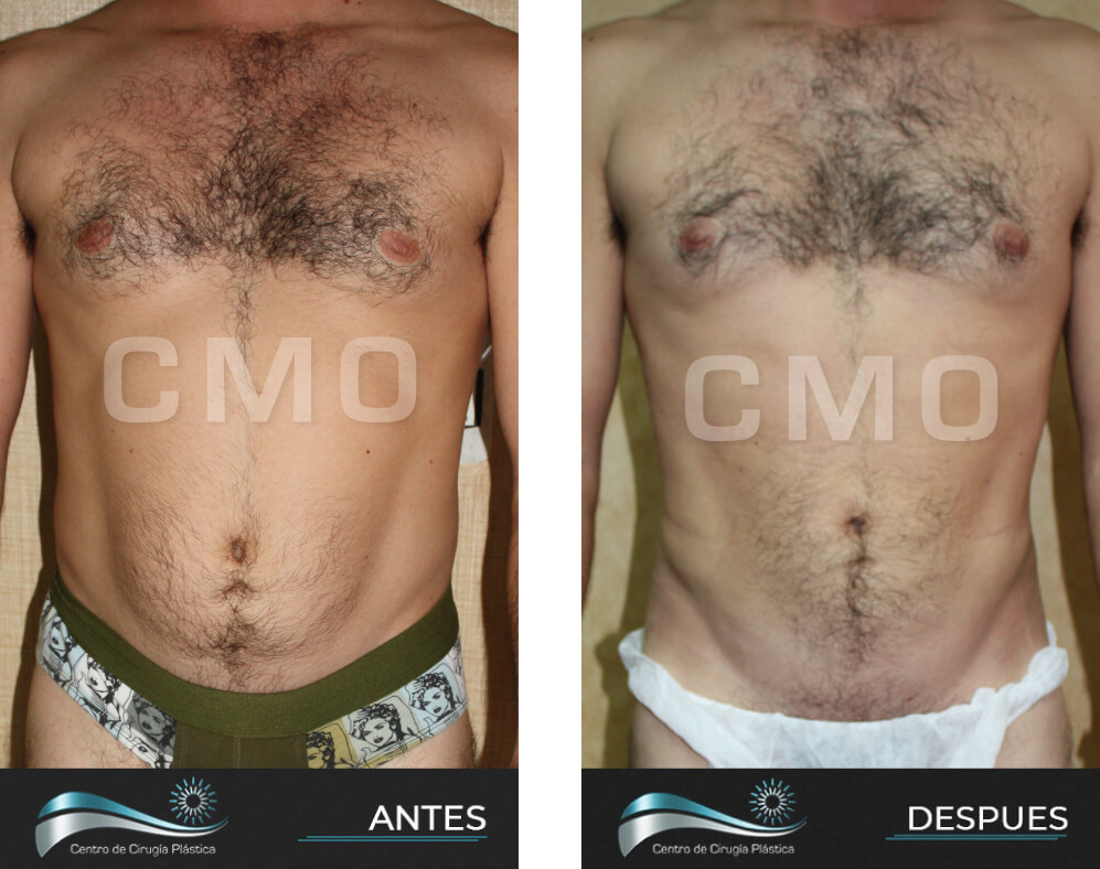 Dr-Marco-Vinicio-Ochoa-Cirugia-Plastica-Estetica-y-Reconstructiva-Quito-CASOS-lipoescultura-4a