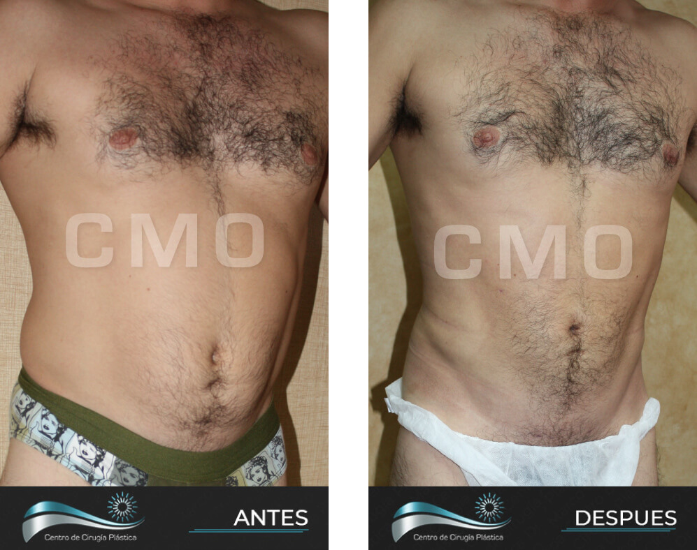 Dr-Marco-Vinicio-Ochoa-Cirugia-Plastica-Estetica-y-Reconstructiva-Quito-CASOS-lipoescultura-4b