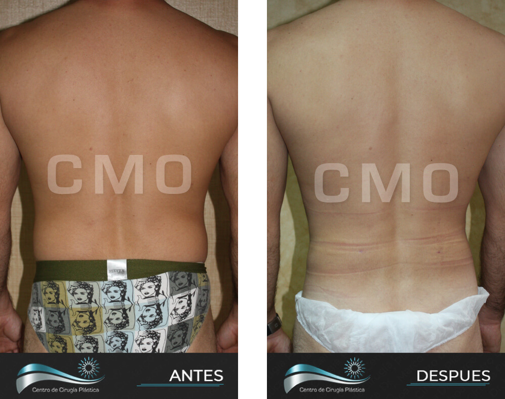 Dr-Marco-Vinicio-Ochoa-Cirugia-Plastica-Estetica-y-Reconstructiva-Quito-CASOS-lipoescultura-4c