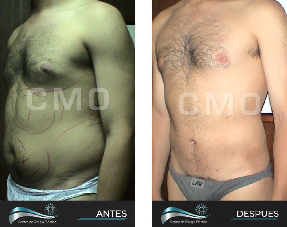 Dr-Marco-Vinicio-Ochoa-Cirugia-Plastica-Estetica-y-Reconstructiva-Quito-CASOS-lipoescultura-5a