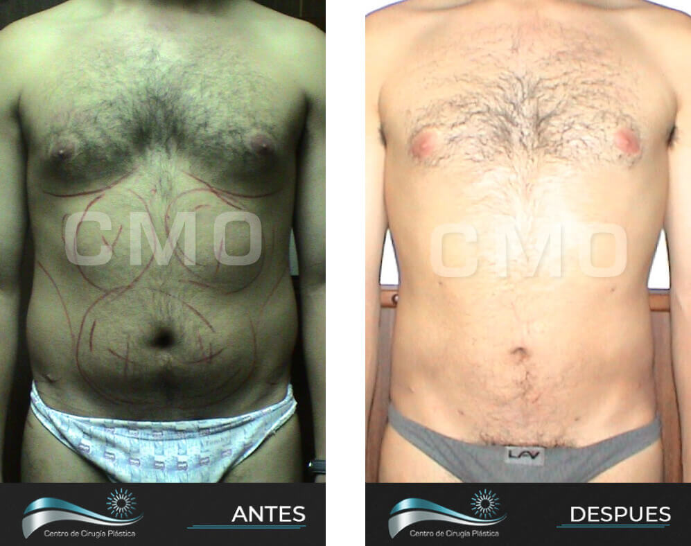 Dr-Marco-Vinicio-Ochoa-Cirugia-Plastica-Estetica-y-Reconstructiva-Quito-CASOS-lipoescultura-5b