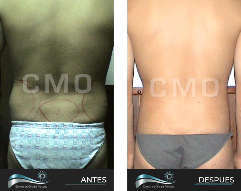 Dr-Marco-Vinicio-Ochoa-Cirugia-Plastica-Estetica-y-Reconstructiva-Quito-CASOS-lipoescultura-5c