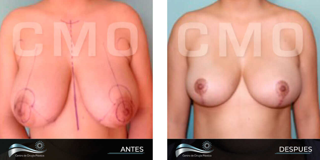 Dr-Marco-Vinicio-Ochoa-Cirugia-Plastica-Estetica-y-Reconstructiva-Quito-CASOS-reduccio-n-de-senos-E1