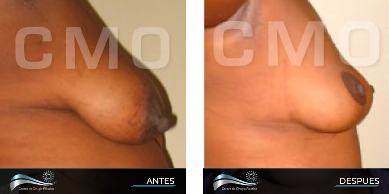 Dr-Marco-Vinicio-Ochoa-Cirugia-Plastica-Estetica-y-Reconstructiva-Quito-CASOS-reduccio-n-de-senos-F1
