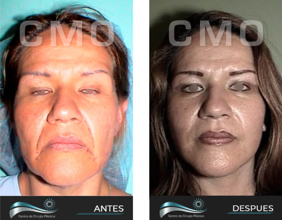 Dr-Marco-Vinicio-Ochoa-Cirugia-Plastica-Estetica-y-Reconstructiva-Quito-CASOS-rejuvenecimiento-facial-a1