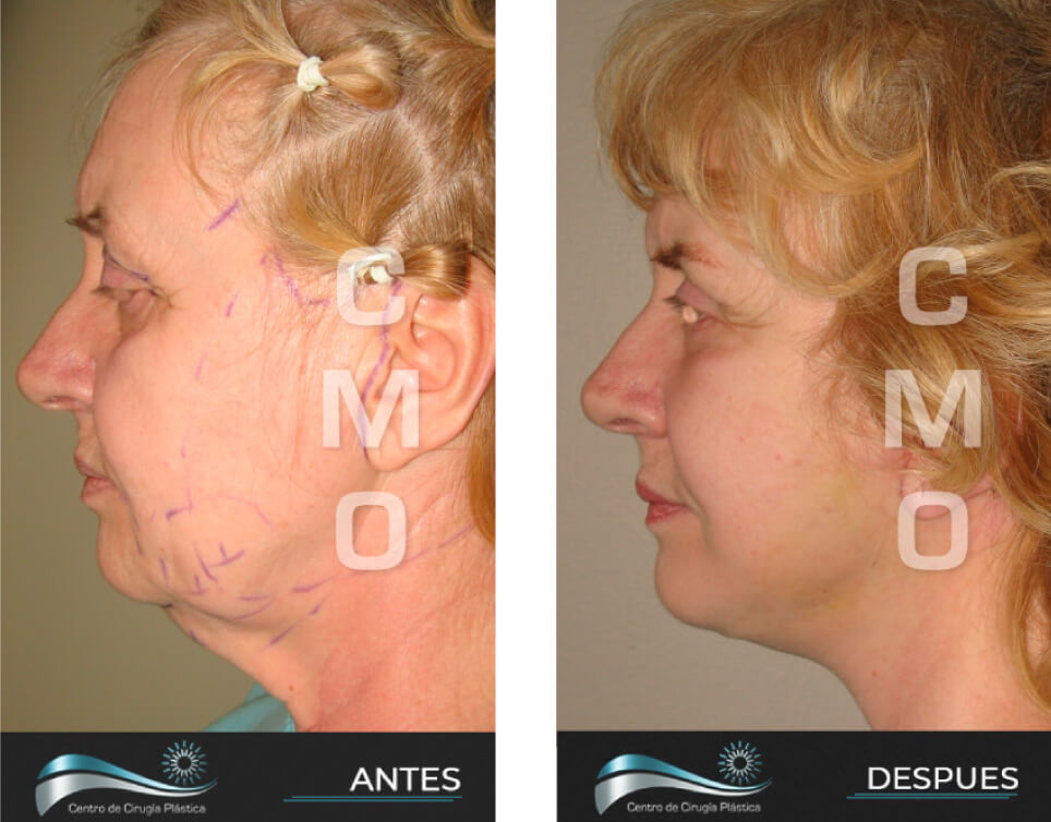Dr-Marco-Vinicio-Ochoa-Cirugia-Plastica-Estetica-y-Reconstructiva-Quito-CASOS-rejuvenecimiento-facial-c2