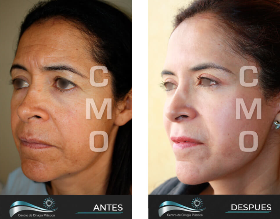 Dr-Marco-Vinicio-Ochoa-Cirugia-Plastica-Estetica-y-Reconstructiva-Quito-CASOS-rejuvenecimiento-facial-d1