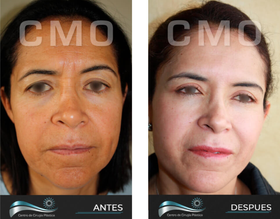 Dr-Marco-Vinicio-Ochoa-Cirugia-Plastica-Estetica-y-Reconstructiva-Quito-CASOS-rejuvenecimiento-facial-d2