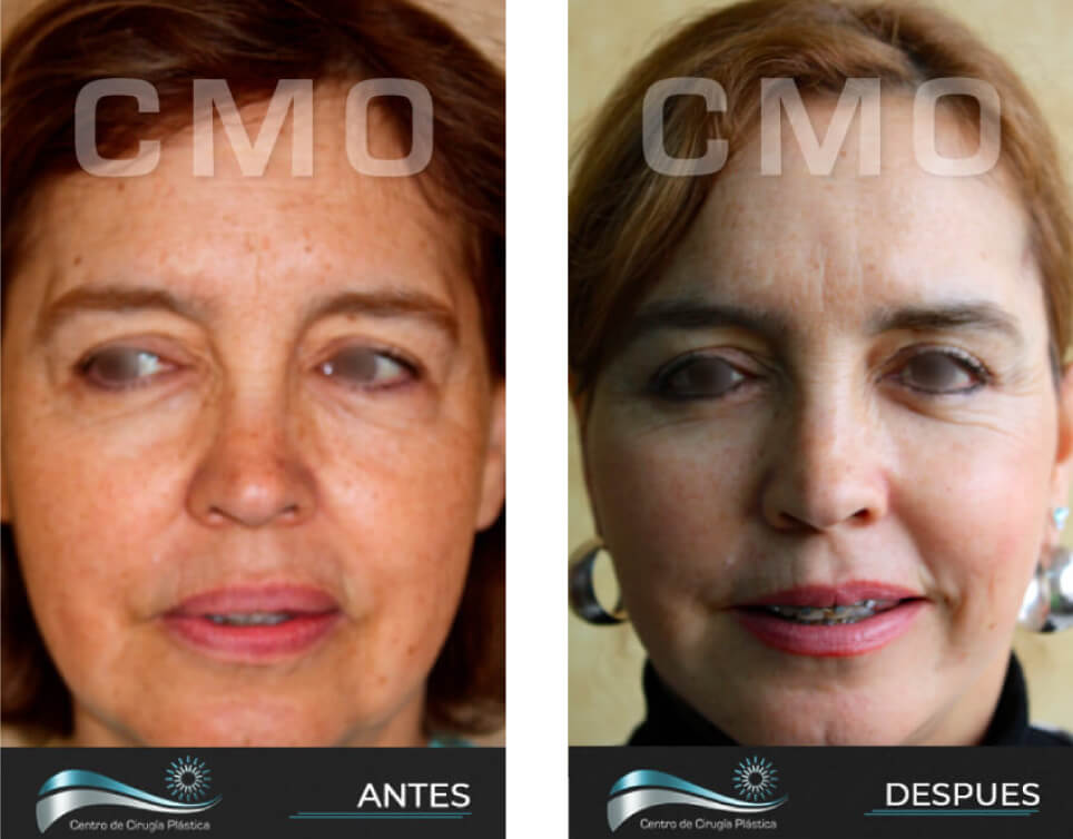 Dr-Marco-Vinicio-Ochoa-Cirugia-Plastica-Estetica-y-Reconstructiva-Quito-CASOS-rejuvenecimiento-facial-e1