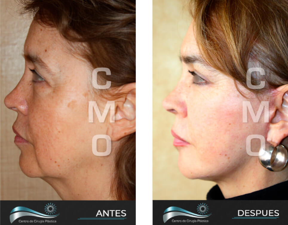 Dr-Marco-Vinicio-Ochoa-Cirugia-Plastica-Estetica-y-Reconstructiva-Quito-CASOS-rejuvenecimiento-facial-e2