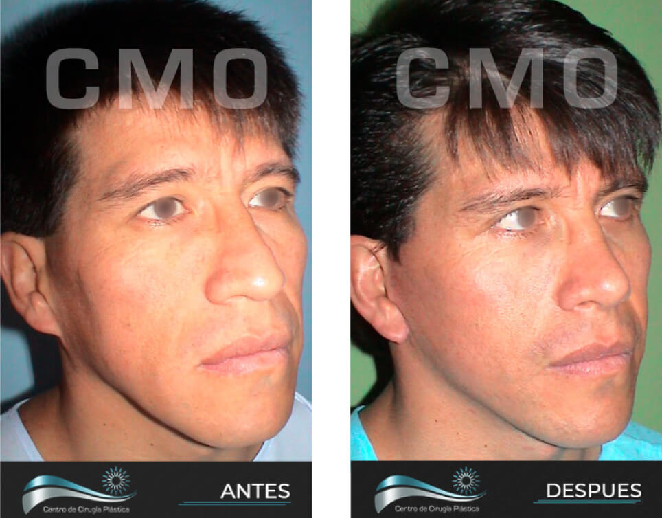 Dr-Marco-Vinicio-Ochoa-Cirugia-Plastica-Estetica-y-Reconstructiva-Quito-CASOS-rejuvenecimiento-facial-f1