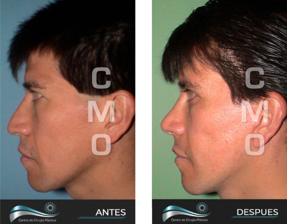 Dr-Marco-Vinicio-Ochoa-Cirugia-Plastica-Estetica-y-Reconstructiva-Quito-CASOS-rejuvenecimiento-facial-f2