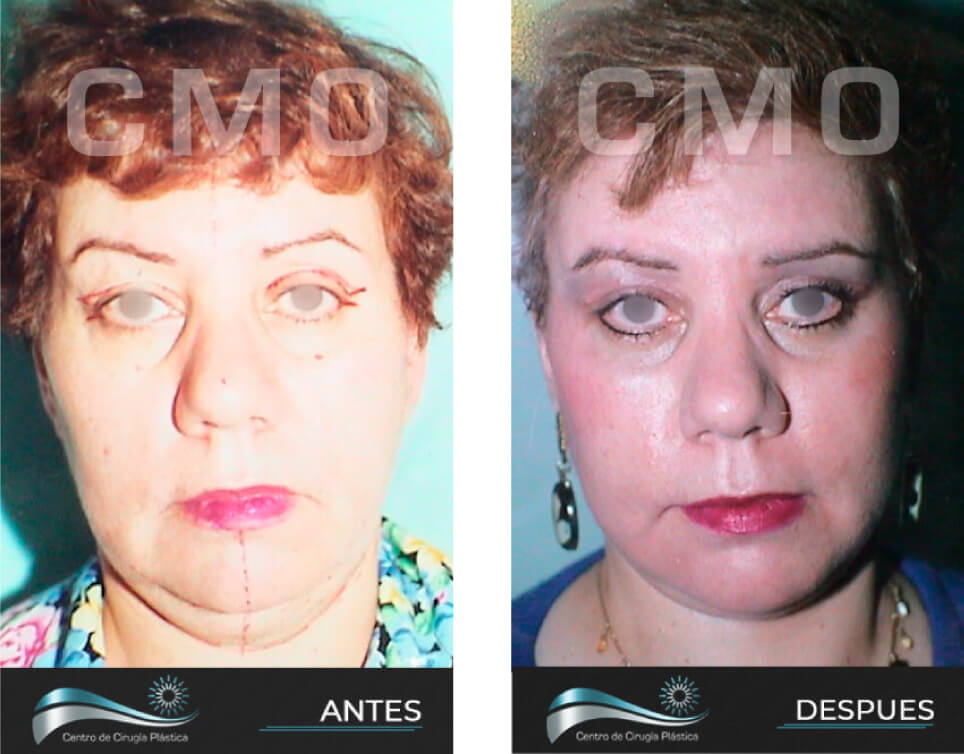 Dr-Marco-Vinicio-Ochoa-Cirugia-Plastica-Estetica-y-Reconstructiva-Quito-CASOS-rejuvenecimiento-facial-g1