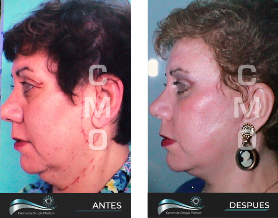 Dr-Marco-Vinicio-Ochoa-Cirugia-Plastica-Estetica-y-Reconstructiva-Quito-CASOS-rejuvenecimiento-facial-g2